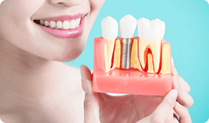 インプラント治療